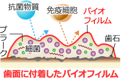 歯面に付着したバイオフィルム