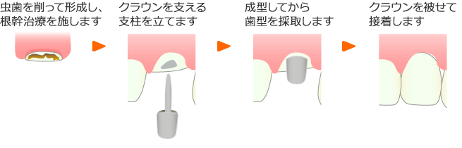 クラウン修復法の治療イメージ