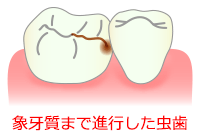 象牙質まで進行したＣ２の虫歯