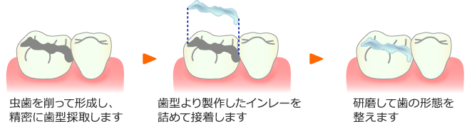 インレー修復法の治療イメージ