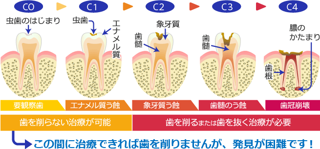 虫歯の進行度による分類