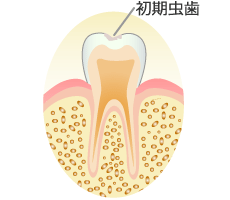 ＣＯ：初期虫歯（要観察歯）の症状と治療