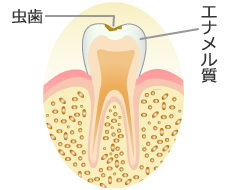 Ｃ１：エナメル質の虫歯（エナメル質う蝕）の症状と治療
