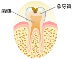 象牙質まで進行したＣ２（象牙質う蝕）の虫歯