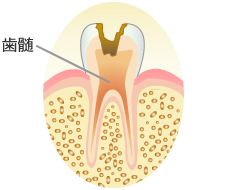 Ｃ３：歯の神経（歯髄）に達した虫歯の症状と治療