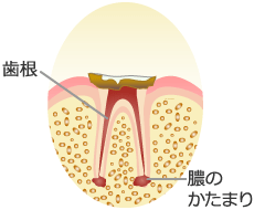 Ｃ４：歯冠部が崩壊した虫歯の症状と治療