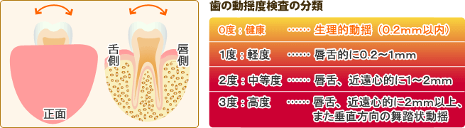 歯周基本検査３：歯の動揺度検査と歯周病の分類