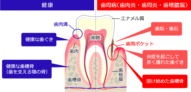 健康な状態と歯周病の比較
