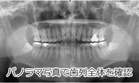 歯周基本検査４：レントゲン検査