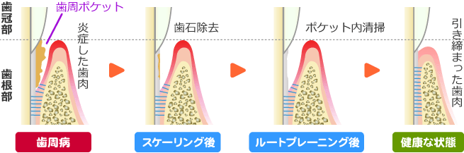 スケーリング・ルートプレーニングの治療イメージ