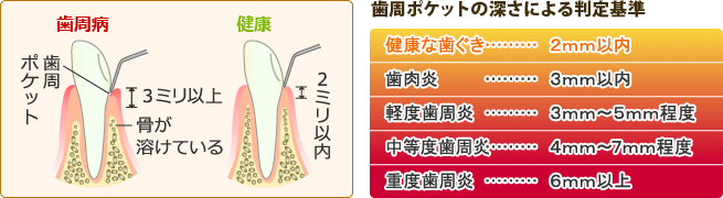 歯周基本検査２：歯周ポケットの深度測定と歯周病判定基準