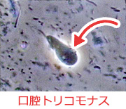 歯周病の原因菌として代表的な原虫“口腔トリコモナス”