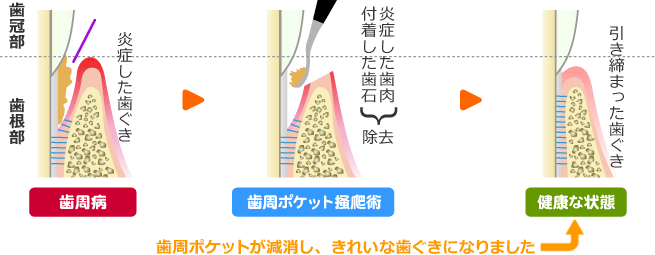 歯周ポケット掻爬（そうは）術の治療イメージ