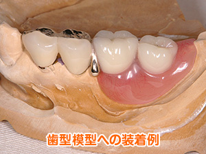 コーヌス（クローネ）義歯 ー 部分入れ歯