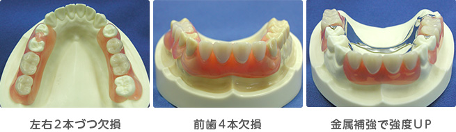 エステティックデンチャーのバリエーション
