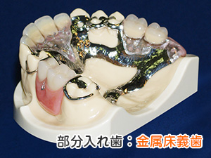 部分入れ歯：金属床義歯