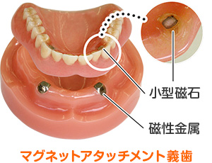 マグネットアタッチメント義歯 ー 総入れ歯・部分入れ歯