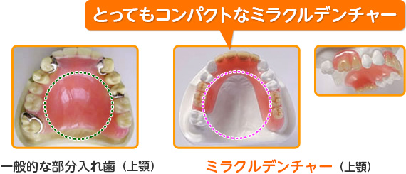 とってもコンパクトなミラクルデンチャー