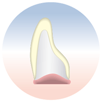 セレックオールセラミックス修復：前歯部クラウン（前歯のかぶせ物）
