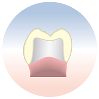 セレックオールセラミックス修復：臼歯部クラウン（奥歯のかぶせ物）