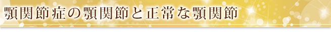 顎関節症の顎関節と正常な顎関節