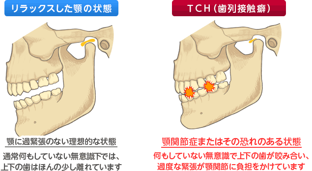 リラックスした顎の状態とＴＣＨ（歯列接触癖）の顎の状態