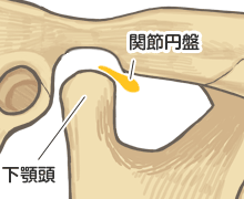 顎関節症の顎関節 - 関節円板が前方に転移