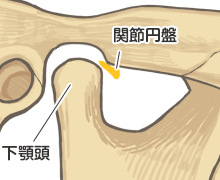 顎関節症の顎関節 - 関節円板の前方転移がさらに大きい